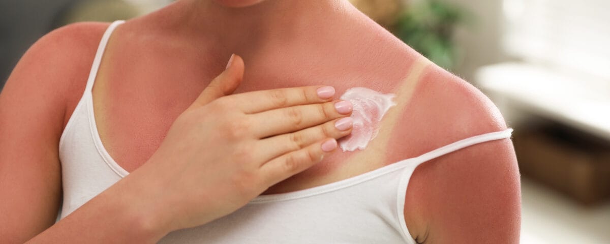 Donna con evidenti scottature che si spalma una crema